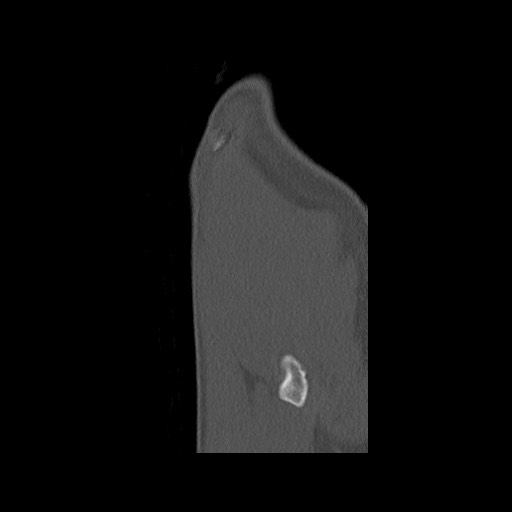 Normal pelvis (Radiopaedia 51473-57238 Sagittal bone window 144).jpg