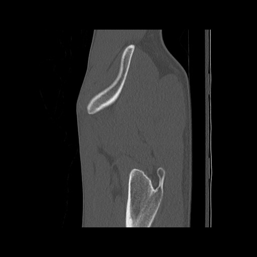 Normal pelvis (Radiopaedia 51473-57238 Sagittal bone window 20).jpg