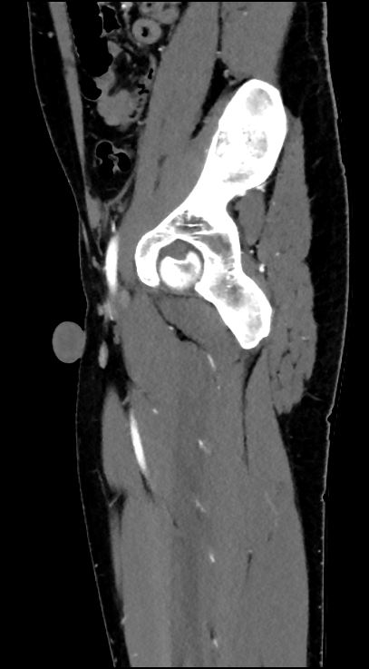 Normal pelvis CT angiogram (Radiopaedia 84966-100481 C 76).jpg