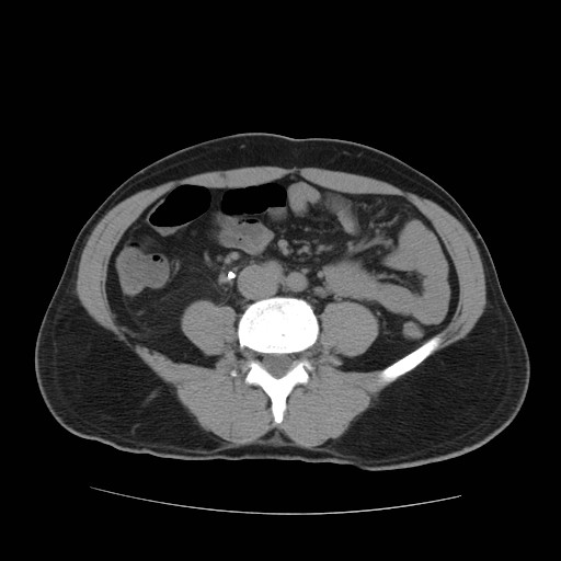File:Obstructed kidney with perinephric urinoma (Radiopaedia 26889-27067 Axial non-contrast 25).jpg