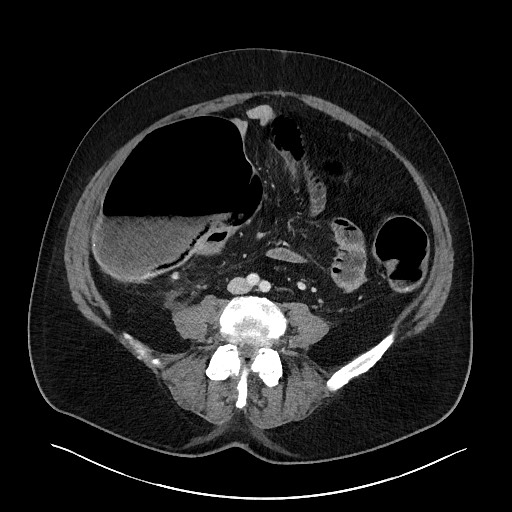 Obstructing sigmoid adenocarcinoma (Radiopaedia 58465-65619 A 104).jpg