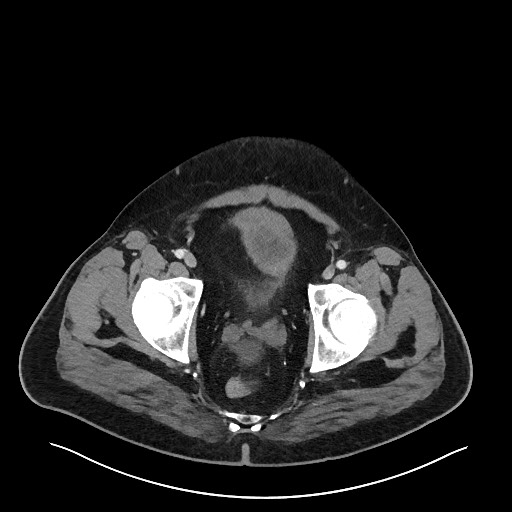 Obstructing sigmoid adenocarcinoma (Radiopaedia 58465-65619 A 149).jpg