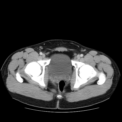File:Obstructing ureteric calculus (Radiopaedia 18615-18514 B 54).jpg