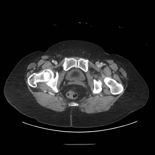 Obstructive distal colonic adenocarcinoma causing cecal perforation (Radiopaedia 86830-102989 A 188).jpg