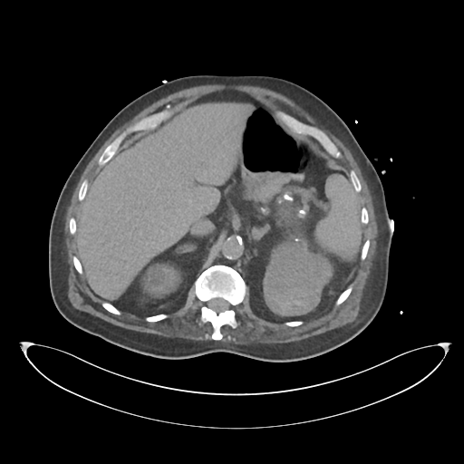 File:Obstructive pyelonephritis (Radiopaedia 46411-50844 Axial non-contrast 24).png