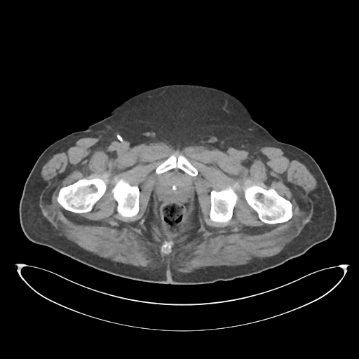 File:Obstructive pyelonephritis (Radiopaedia 46411-50844 Axial non-contrast 80).png