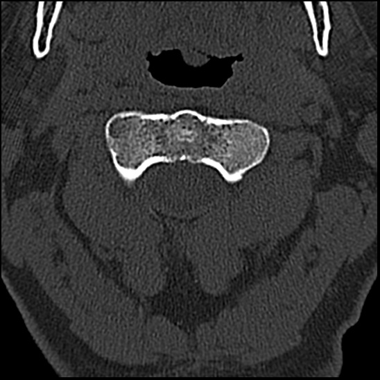 Occipital condyle fracture (type 1) (Radiopaedia 87670-104084 Axial bone window 26).jpg
