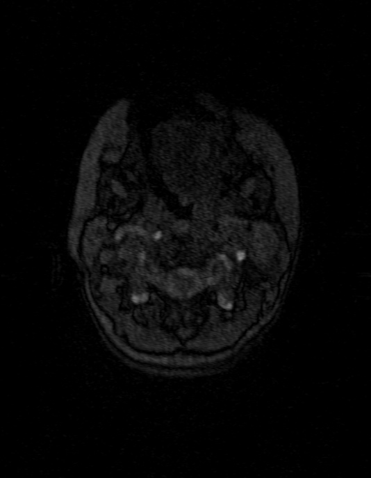 Occipital horn syndrome (Radiopaedia 14255-14129 MRA 1).jpg