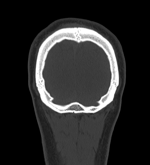Occipital spur and Currarino type A atlas anomaly (Radiopaedia 87027-103285 Coronal bone window 130).jpg