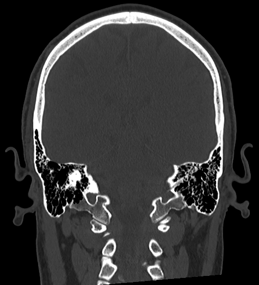 Occipital spur and Currarino type A atlas anomaly (Radiopaedia 87027-103285 Coronal bone window 95).jpg