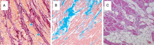 a-c) Histological abnormalities in cardiomyopathy