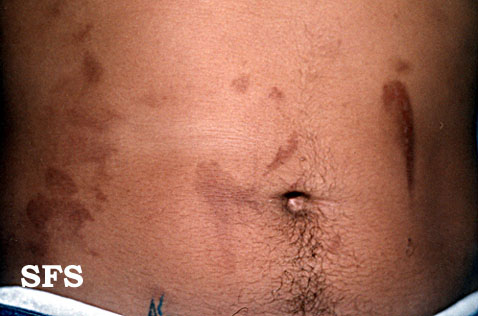 File:Phytophotodermatitis (Dermatology Atlas 2).jpg