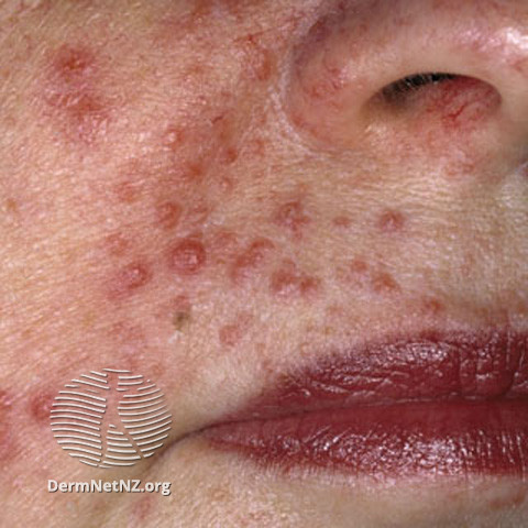Rosacea (DermNet NZ acne-red-face-3632).jpg