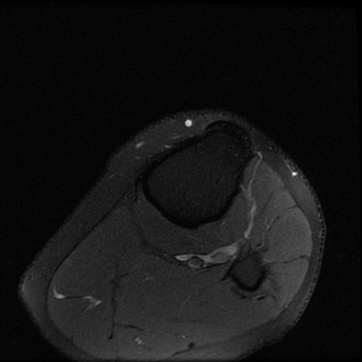 File:ACL and meniscal tears (Radiopaedia 79604-92797 Axial PD fat sat 27).jpg