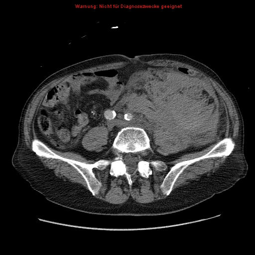 File:Abdominal aortic aneurysm- extremely large, ruptured (Radiopaedia 19882-19921 Axial C+ arterial phase 50).jpg