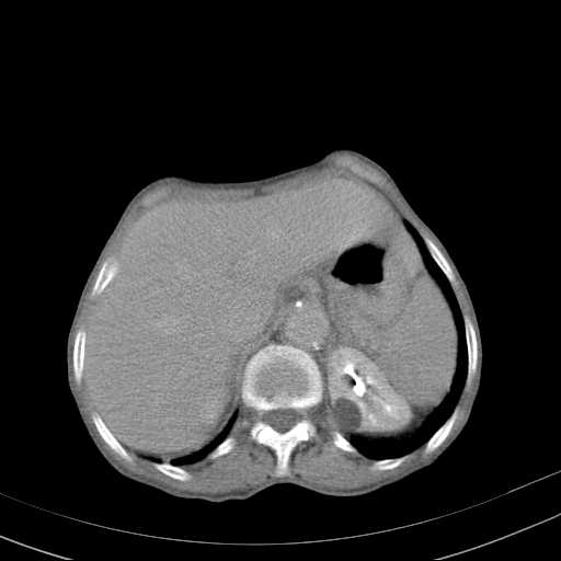 File:Abdominal aortic aneurysm (Radiopaedia 20827-20742 Axial C+ delayed 5).jpg
