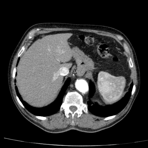 Abdominal aortic aneurysm (Radiopaedia 29248-29660 Axial C+ arterial phase 14).jpg