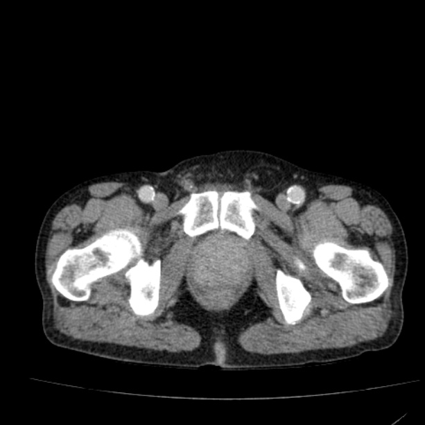 Abdominal aortic aneurysm (Radiopaedia 29248-29660 Axial C+ portal venous phase 63).jpg