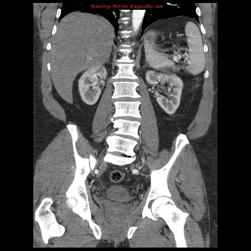 Abdominal aortic aneurysm (Radiopaedia 8190-9038 Coronal C+ arterial phase 83).jpg