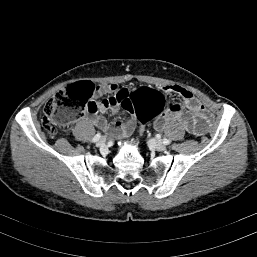 Abdominal aortic aneurysm (Radiopaedia 83581-98689 Axial C+ portal venous phase 84).jpg