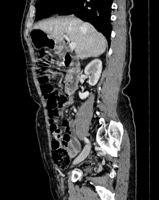 Abdominal aortic aneurysm (Radiopaedia 83581-98689 Sagittal C+ portal venous phase 15).jpg