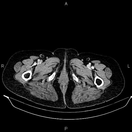 File:Abdominal aortic aneurysm (Radiopaedia 85063-100606 Axial C+ portal venous phase 71).jpg