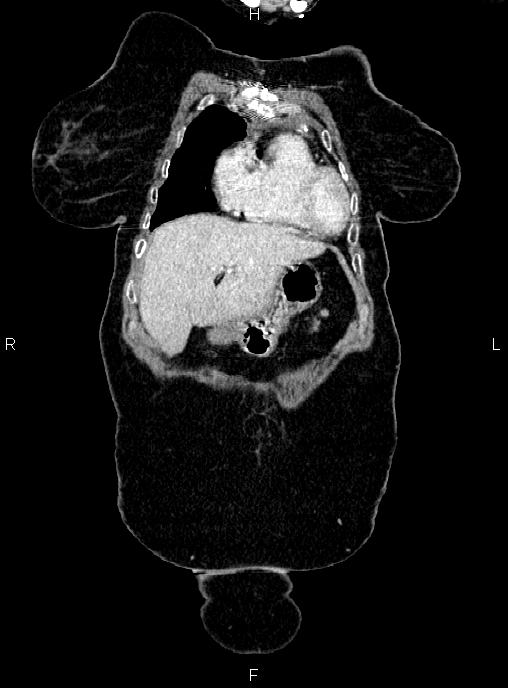 Abdominal aortic aneurysm (Radiopaedia 85063-100606 Coronal C+ arterial phase 3).jpg