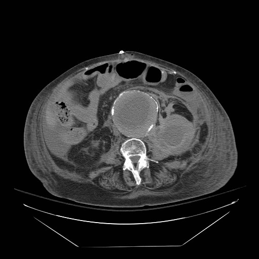 Abdominal aortic aneurysm - impending rupture (Radiopaedia 19233-19247 Axial non-contrast 95).jpg