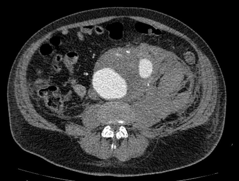 Abdominal aortic aneurysm rupture (Radiopaedia 54179-60362 Axial C+ portal venous phase 16).jpg