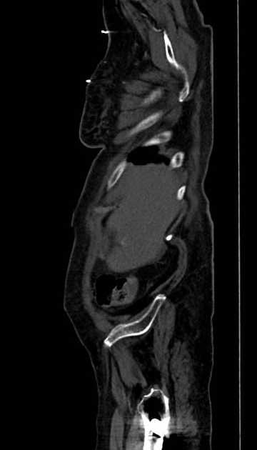 Abdominal aortic aneurysm with thrombus fissuration (Radiopaedia 73192-83919 Sagittal C+ arterial phase 130).jpg