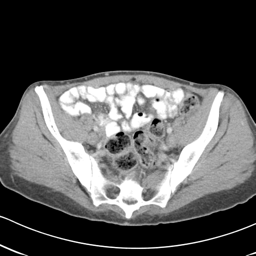 Abdominal desmoid tumor (Radiopaedia 41007-43740 Axial C+ portal venous phase 57).png