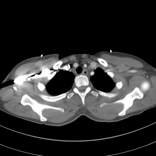 File:Abdominal multi-trauma - devascularised kidney and liver, spleen and pancreatic lacerations (Radiopaedia 34984-36486 Axial C+ arterial phase 15).png