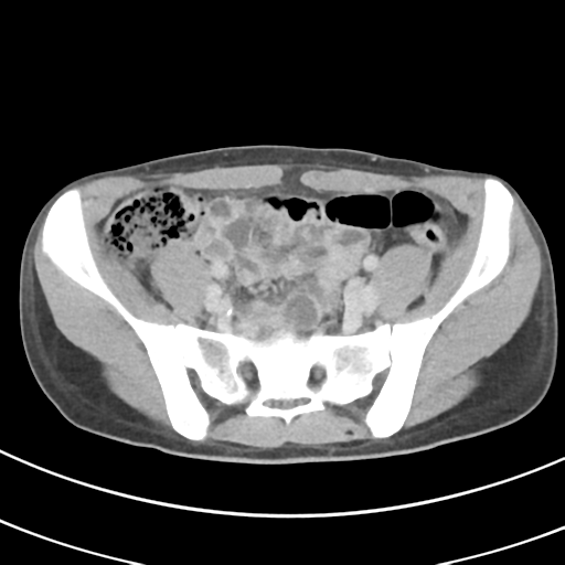 File:Abdominal multi-trauma - devascularised kidney and liver, spleen and pancreatic lacerations (Radiopaedia 34984-36486 Axial C+ delayed 60).png