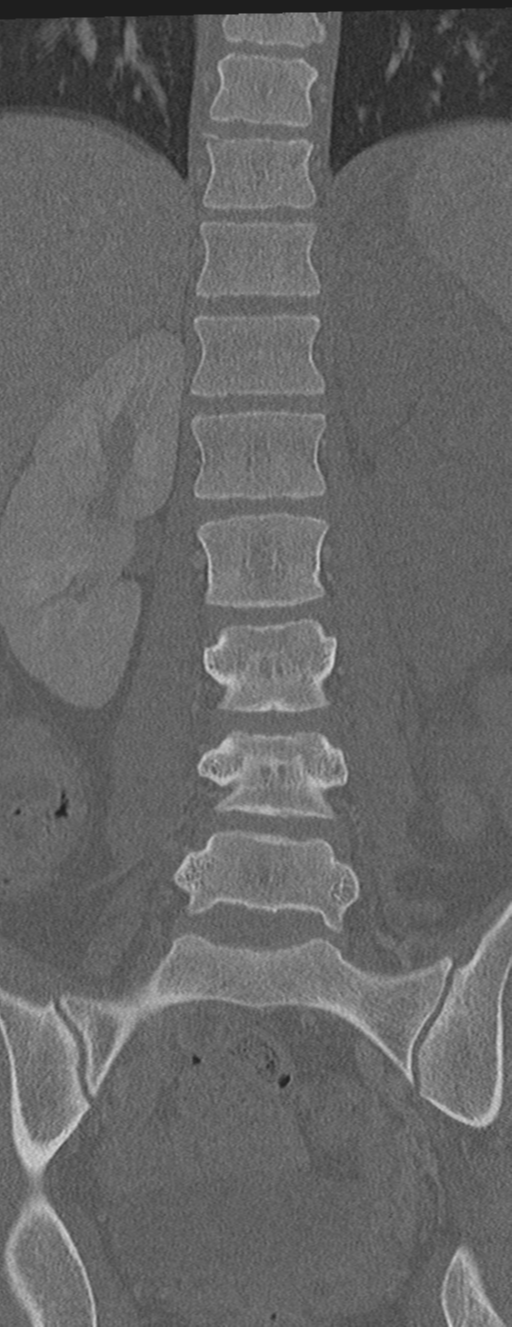 Abdominal multi-trauma - devascularised kidney and liver, spleen and pancreatic lacerations (Radiopaedia 34984-36486 Coronal bone window 34).png