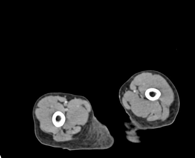 Abdominopelvic rhabdomyosarcoma (Radiopaedia 78356-90984 Axial C+ portal venous phase 175).jpg
