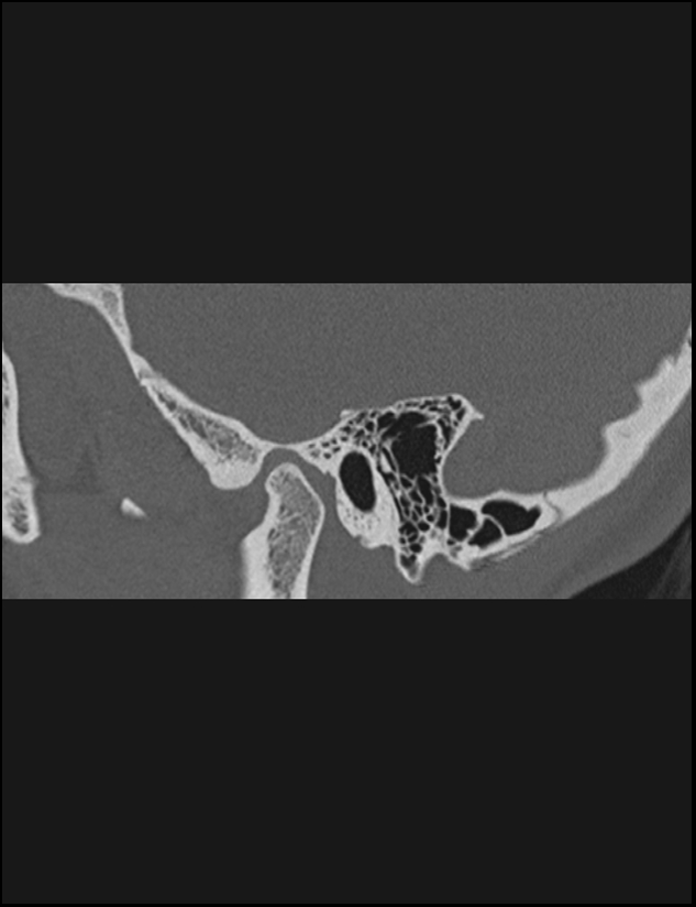 Aberrant right internal carotid artery (Radiopaedia 65191-74198 Sagittal non-contrast 34).jpg