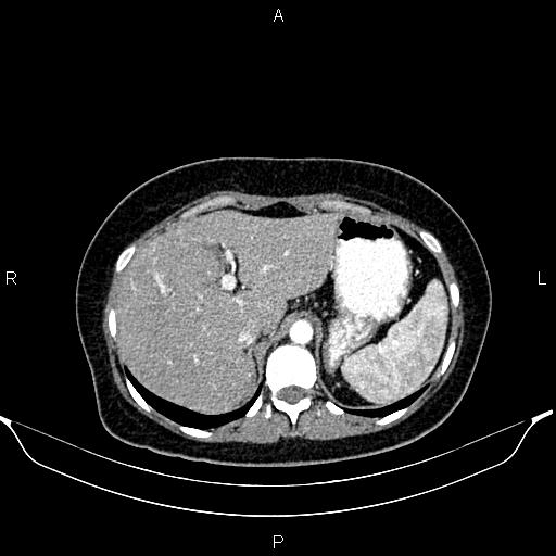Aberrant right subclavian artery (Radiopaedia 87334-103629 Axial C+ arterial phase 64).jpg