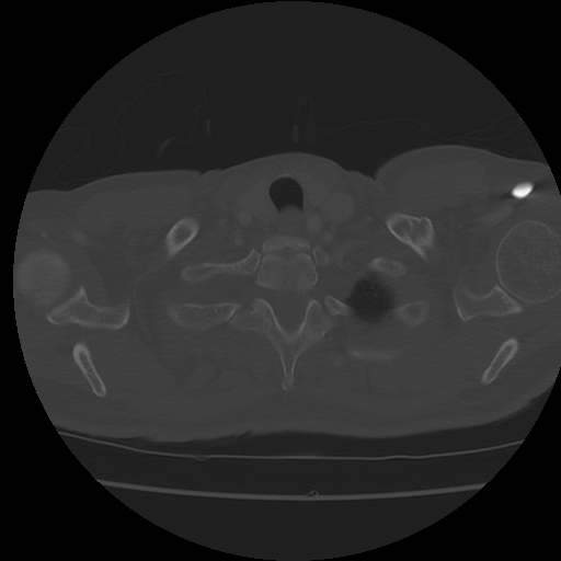 Aberrant right subclavian artery (arteria lusoria) (Radiopaedia 66584-75879 Axial C+ arterial phase 6).png