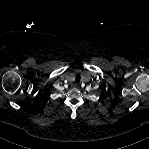 File:Aberrant right subclavian artery with Kommerell diverticulum (Radiopaedia 47982-52769 Axial C+ arterial phase 7).png