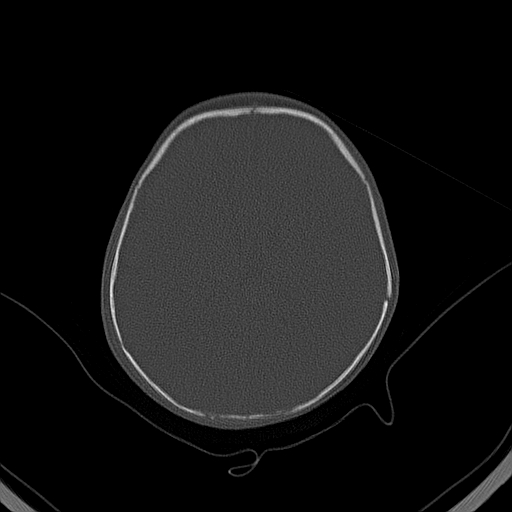 File:Accessory intraparietal suture (Radiopaedia 50584-56020 Axial bone window 28).jpg