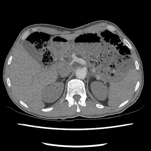 Accessory left horizontal fissure with lingular pneumonia (Radiopaedia 53763-59843 Axial C+ CTPA 92).jpg
