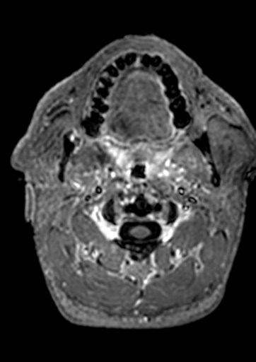 File:Accessory middle cerebral artery (Radiopaedia 73114-83828 Axial T1 C+ 231).jpg
