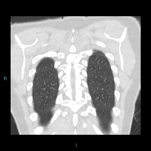 Accidental foreign body aspiration (seamstress needle) (Radiopaedia 77740-89983 Coronal lung window 5).jpg
