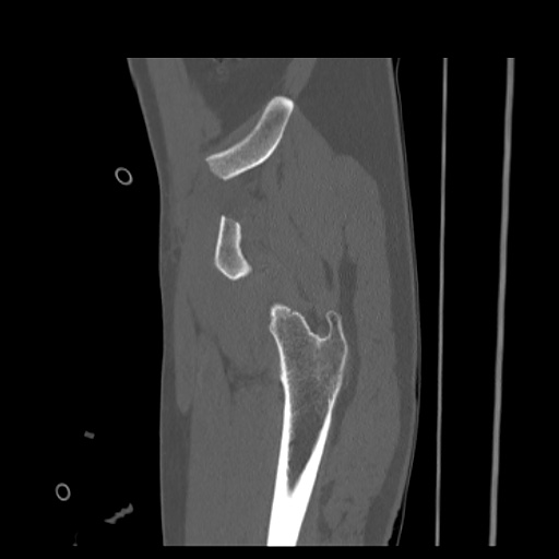 Acetabular and ilial fractures (Radiopaedia 59084-66378 Sagittal bone window 14).jpg