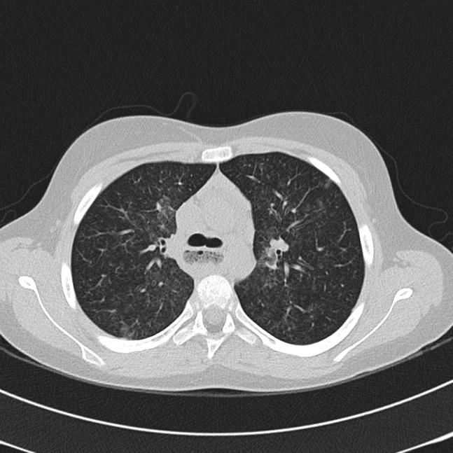 Achalasia (Radiopaedia 14946-14878 Axial lung window 23).jpg