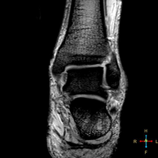 File:Achilles tendon complete tear (Radiopaedia 22834-22854 T2 fat sat 8).jpg