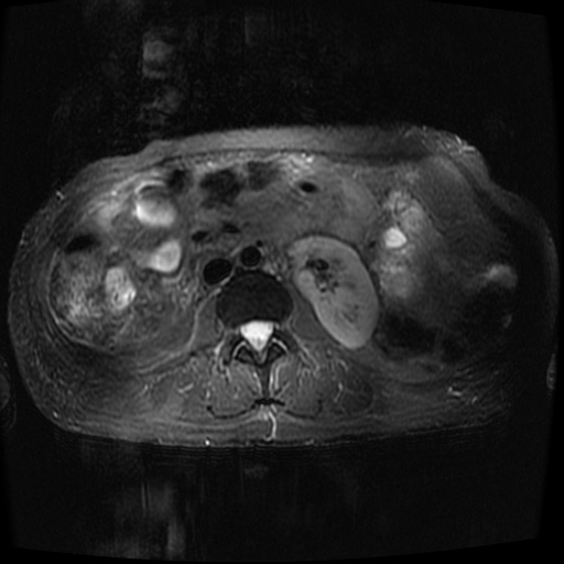 Acinar cell carcinoma of the pancreas (Radiopaedia 75442-86668 Axial T2 fat sat 48).jpg