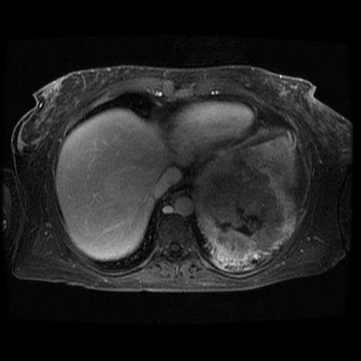 Acinar cell carcinoma of the pancreas (Radiopaedia 75442-86668 D 127).jpg