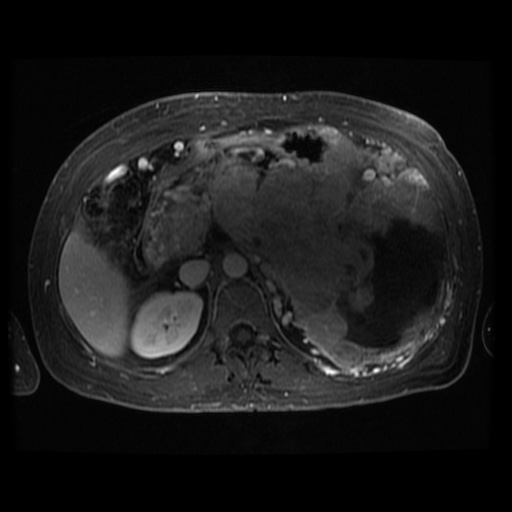 Acinar cell carcinoma of the pancreas (Radiopaedia 75442-86668 D 63).jpg