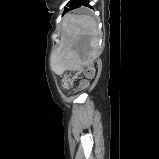 Acinar cell carcinoma of the pancreas (Radiopaedia 75442-86669 Sagittal C+ portal venous phase 167).jpg